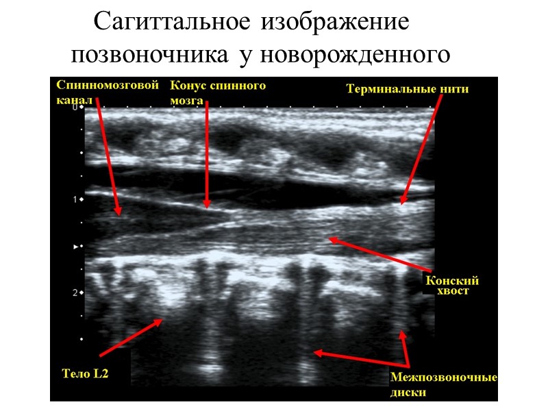 Сагиттальное изображение позвоночника у новорожденного